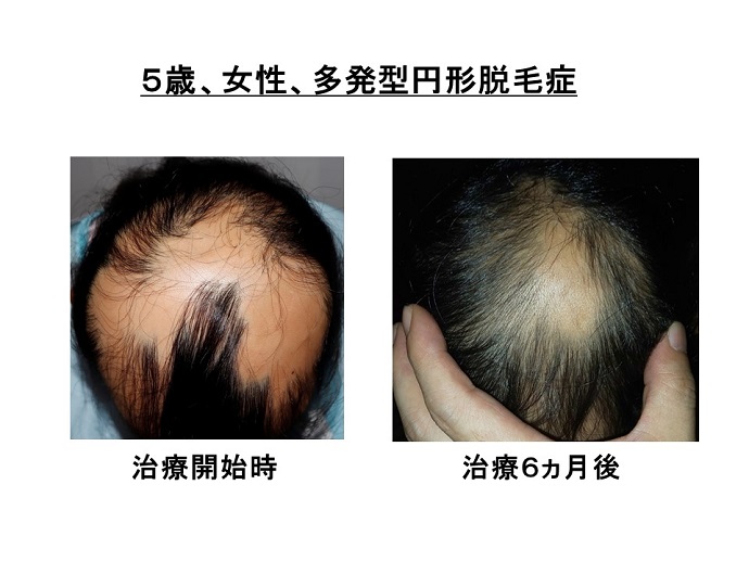 円形脱毛症　病院